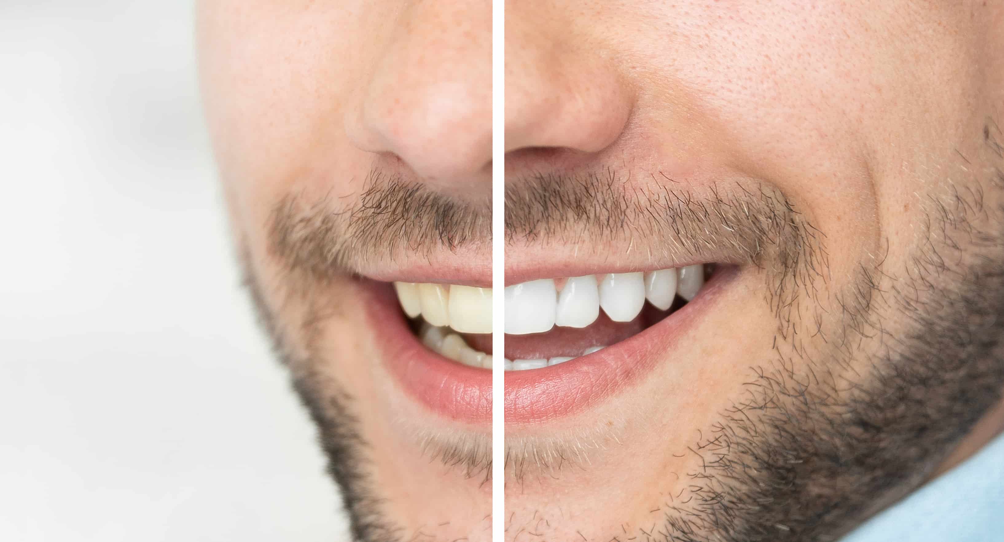 How long does it take to whiten teeth?